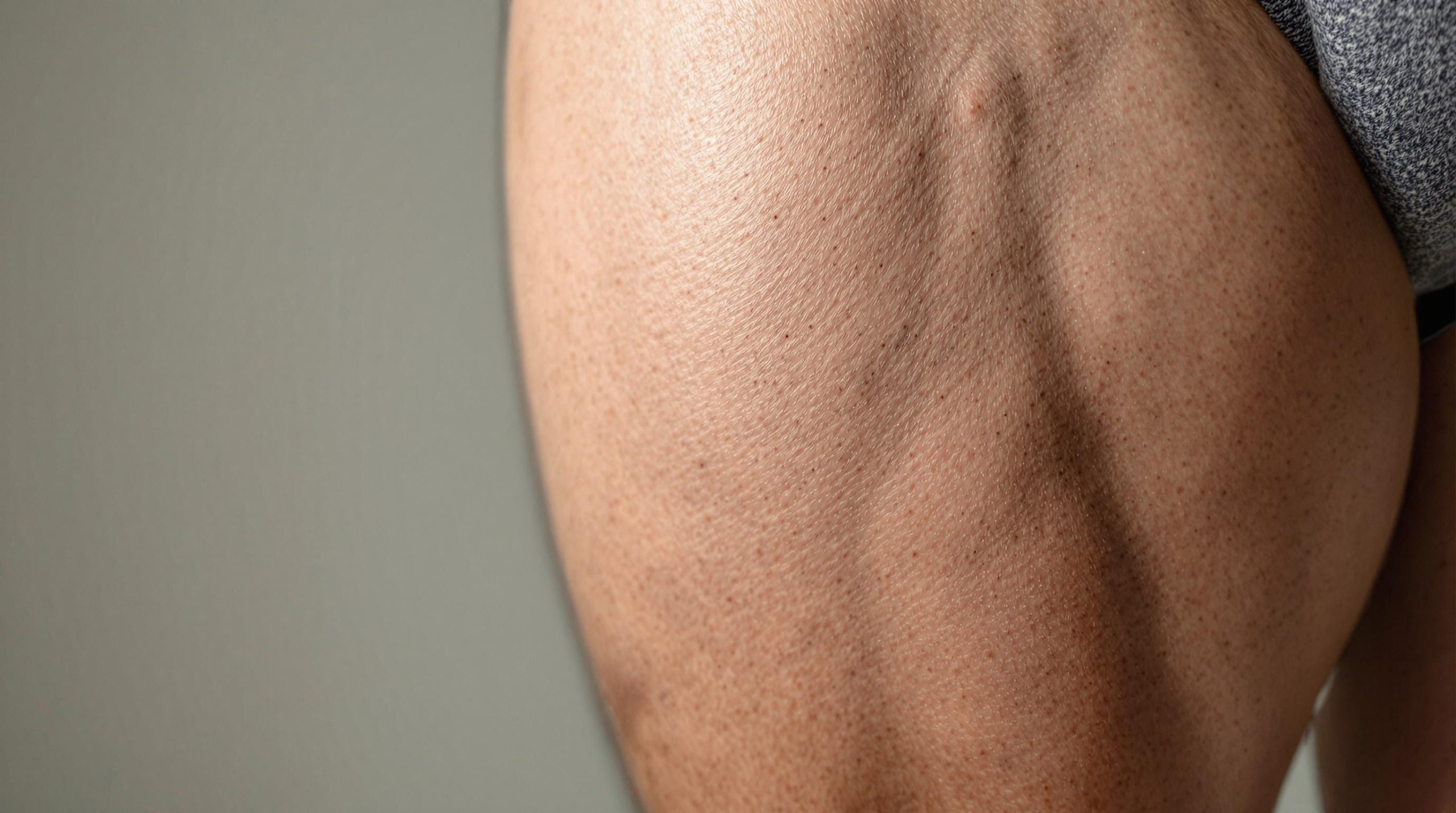 Vergetures sur les cuisses chez l'homme : causes et solutions